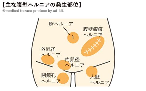 水戸 鼠径部|水戸市の鼠径ヘルニア (そけいヘルニア)/脱腸の専門治療が可能。